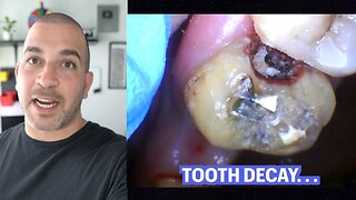 Monster Tooth Decay under Dental Bridge {Procedure Review}