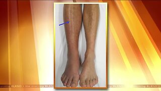 Addressing and Treating Problematic Vein Issues