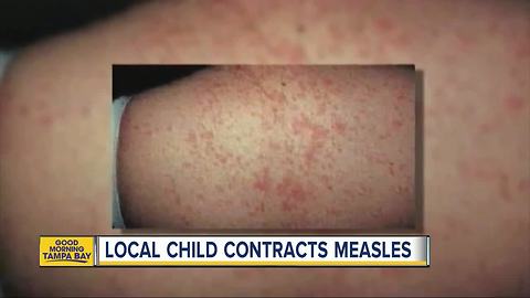 Unvaccinated child contracts measles in Pinellas County