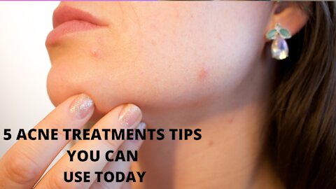 5 Acne treatment tips you can use today