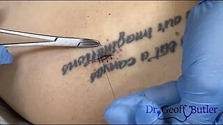 Preserving a tattoo while removing scar tissue