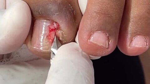 Se você tem medo de remoção de unha encravada, assista a esse vídeo #ingrown_toenail #unhaencravada