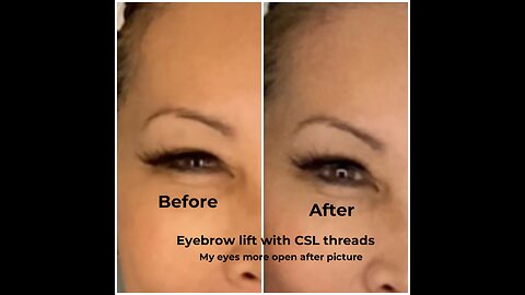 Lifting Eyebrows with threads CSL 23G38mm