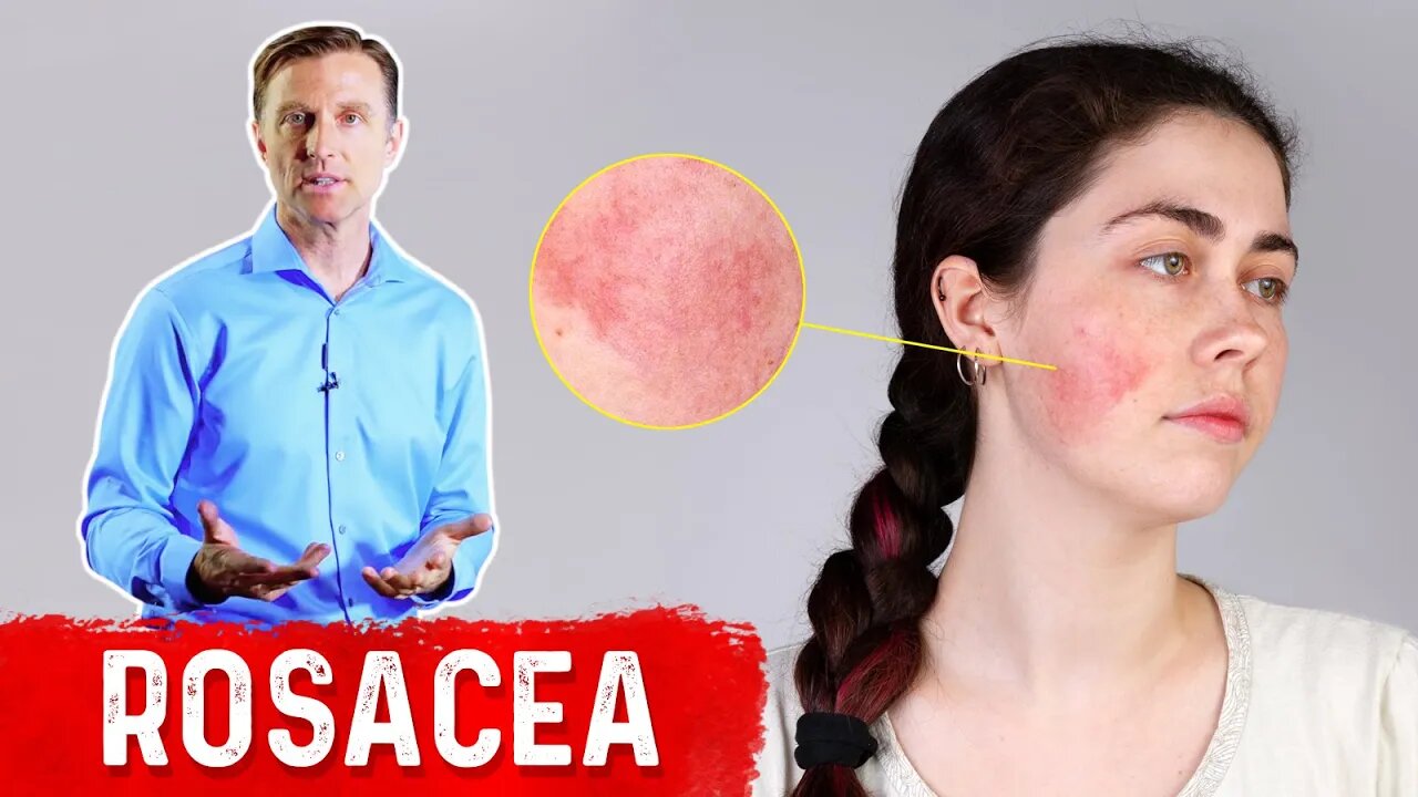 What can be done for rosacea?