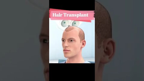 Hair transplantation tiktok biopsychosociale