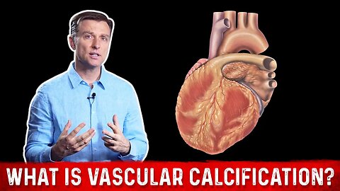 What Is Vascular Calcification? – Dr.Berg