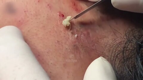 Exploding pimples and blackheads Satisfactory I Skin Cleansing I Blackhead removal