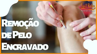 Remoção de Pelo Encravado - Asmr - Just Relax | Apenas Relaxe