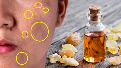 How to Remove Age Spots with Frankincense Oil