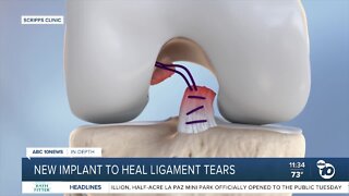 New implant to heal ligament tears
