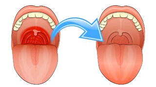 Top 10 Natural Remedies for Sore Throats