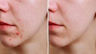 This Secret Recipe Can Cure Your Acne Without Chemicals!