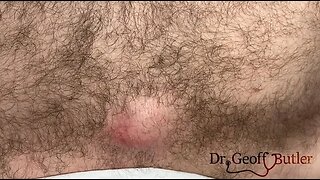 Drainage of an infected cyst on the chest