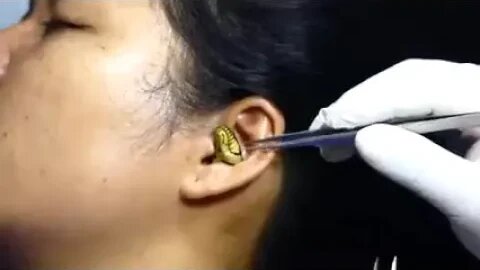 Snake Gets Stuck In Woman's Ear