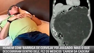 Homem Com Barriga Volumosa Foi Desacreditado. Mas O Que Descobriram Nele, Fez Os Médicos...