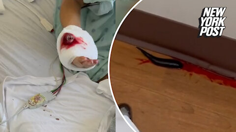 Runaway leech leaves trail of blood in viral TikTok