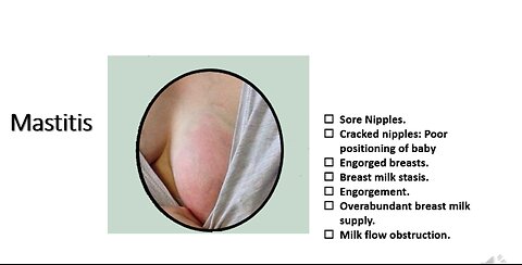 72. Breast Engorgement: Blocked ducts: Mastitis: White spot - nipple