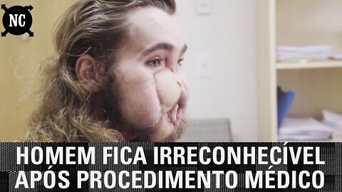 Homem fica irreconhecível após procedimento médico. Ele nunca mais será o mesmo