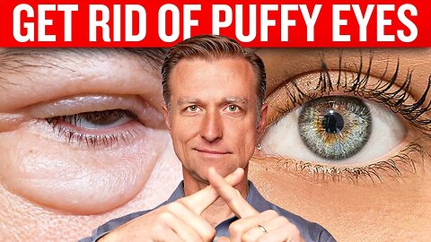 Get Rid of Puffy Eyes for Good with Dr. Berg's Proven Techniques