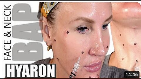 Face & Neck BAP Technique // Hyaron // Facial Rejuvenation