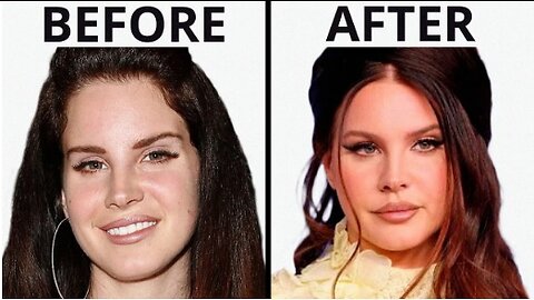 Lana Del Rey's SHOCKING Transformation | Plastic Surgery Analysis