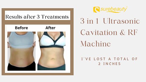 3 in 1 Ultrasonic Cavitation and RF Machine - Before/After