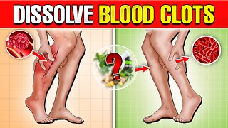 7 Vitamins To DISSOLVE BLOOD CLOTS