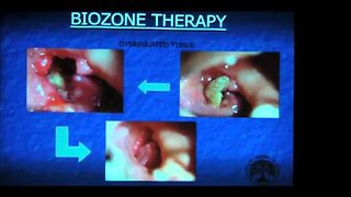 Oxygen/Ozone Treatments in Dentistry Part 2