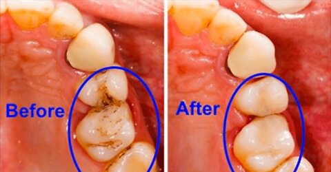 How To Stop Cavities and Treat Your Teeth and Gums