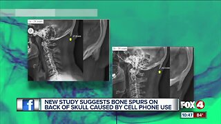 New study suggests bone spurs on skull caused by cell phone use