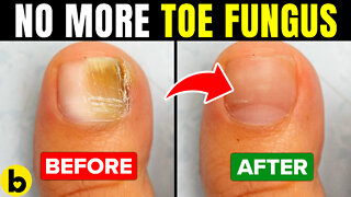 12 Ways To Get Rid of Toenail Fungus Fast and Naturally