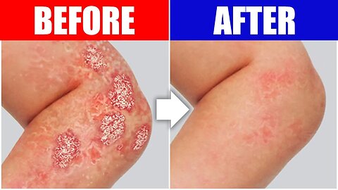 Psoriasis Relief: The Best Remedy For Your Skin