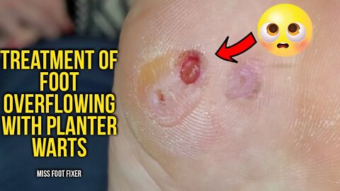 2022 TREATMENT OF A FOOT OVERFLOWING WITH PLANTAR WARTS BY FOOT SPECIALIST MISS FOOT FIXER