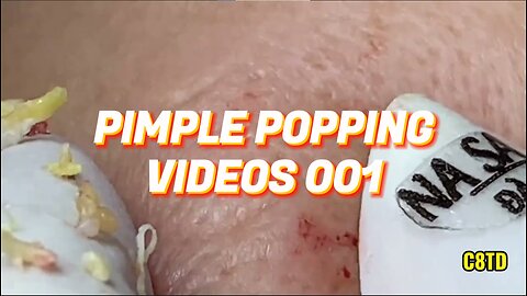 Satisfying Pimple Popping Videos 001