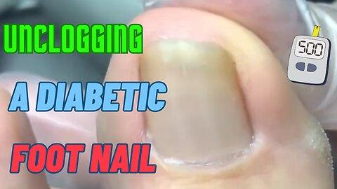 Unclogging a Diabetic Foot Nail