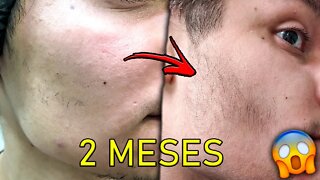 2 MESES USANDO MINOXIDIL