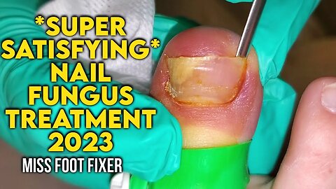 *Super Satisfying* Treating a Nail fungus [2023] By Podiatrist Miss Foot Fixer