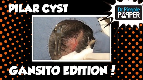 Pilar Cyst on the Head: Gansito Edition