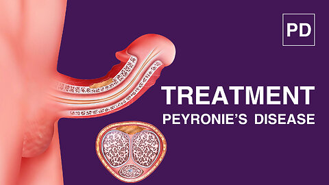 Shockwave therapy for Peyronies Disease, Disorder, bent, and curvature. Treatments and cure.