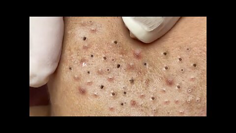 Removing Acne and Blackheads Treatment, #46