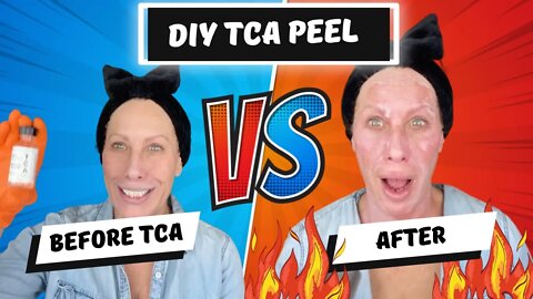 DIY TCA Peel on Face & Neck ~ It’s Worth It