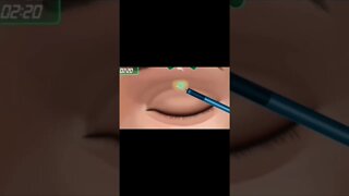 Asmr| cataract surgery| eyes muscle| glaucoma| corneal transplant|