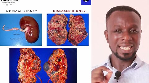 How to Detoxify Your Kidneys: Simple home remedies
