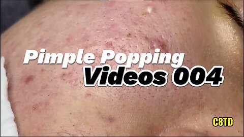 Satisfying Pimple Popping Videos 004