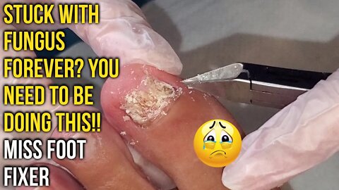 STUCK WITH FUNGUS FOREVER? YOU NEED TO BE DOING THIS!! BY FAMOUS FOOT DOCTOR MISS FOOT FIXER