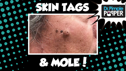 Dr Pimple Popper: Holy MOLE-y! & Skin Tags