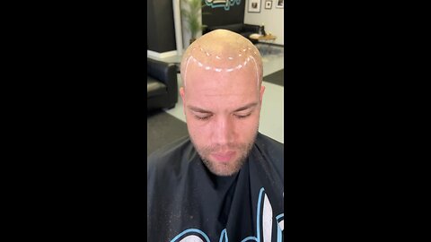 Scalp Micropigmentation