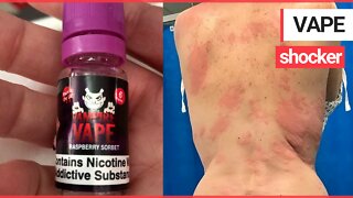 A mum was left with painful burn-like rashes after a serious allergic reaction to VAPING