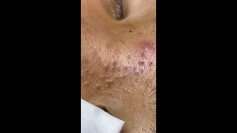 deep cleaning pimple