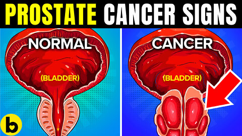 10 Warning Signs You May Have Prostate Cancer